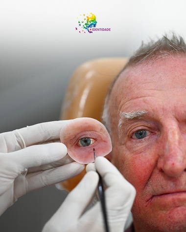 Paciente com sequelas de cancer que recebeu prótese ocular.